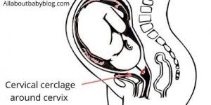 Prevent preterm birth with a cervical cerclage - All about Baby Blog